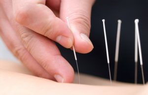 The Benefits Of Visiting A Clinic For Acupuncture, NJ