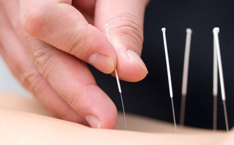 The Benefits Of Visiting A Clinic For Acupuncture, NJ