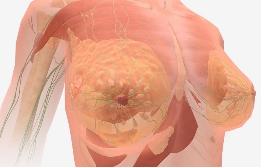 Do you know about the facts, symptoms, and types of metastatic cancer