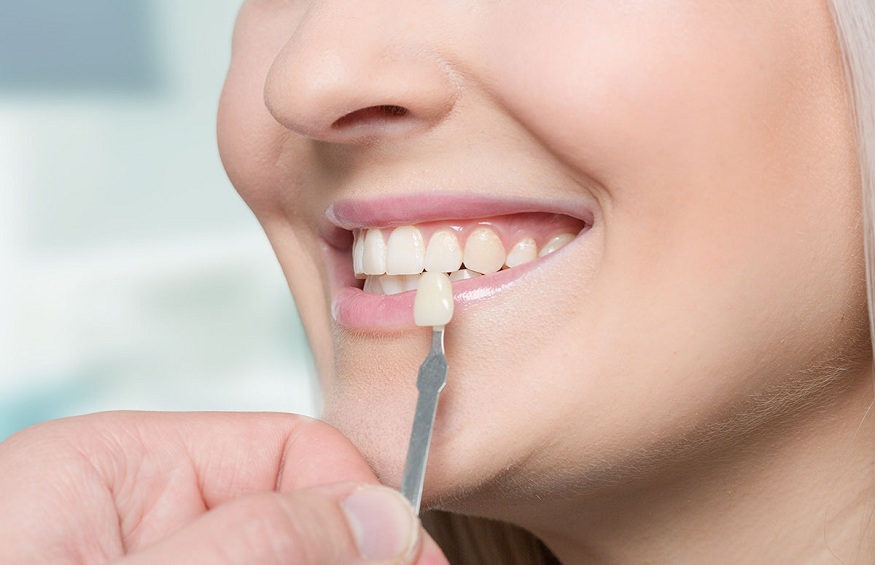 5 Benefits of Porcelain Veneers You Must Know