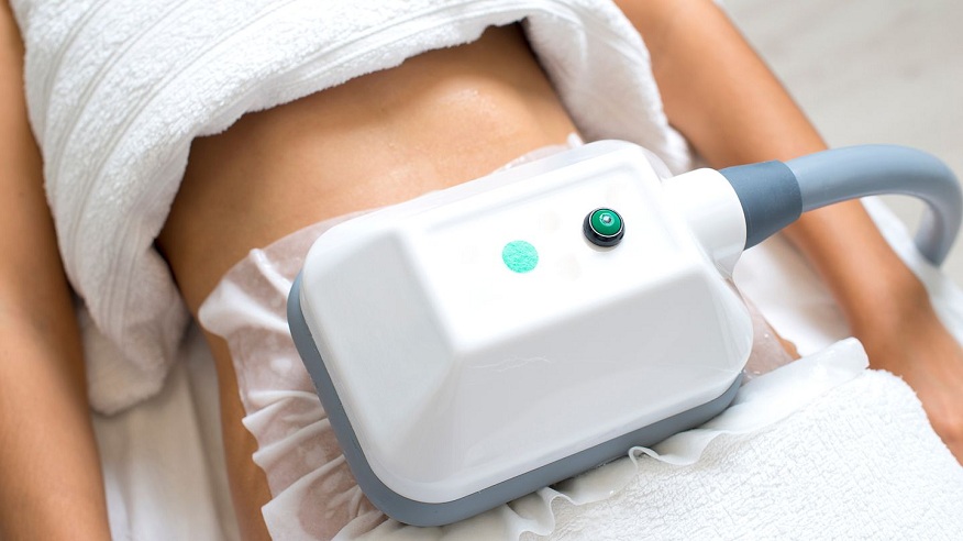 What to Expect After CoolSculpting