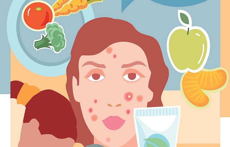 Diet in Acne Treatment