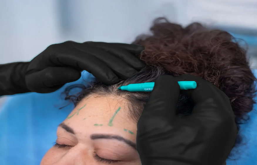 Forehead Reduction Surgery: Personalized Hairline Lowering at EyeFACE Institute, Toronto